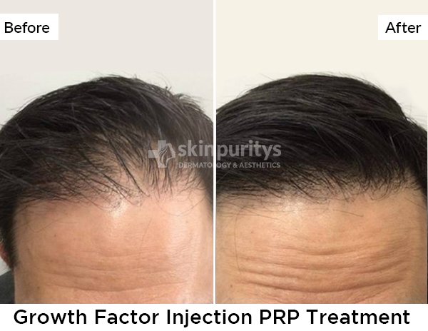 PRP Treatment