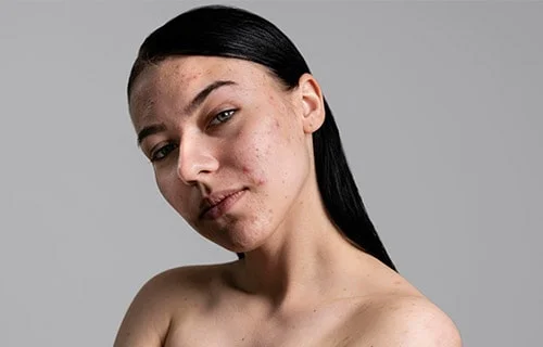 acne scar treatment