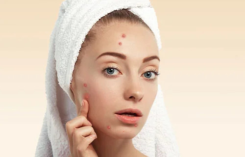 acne treatment