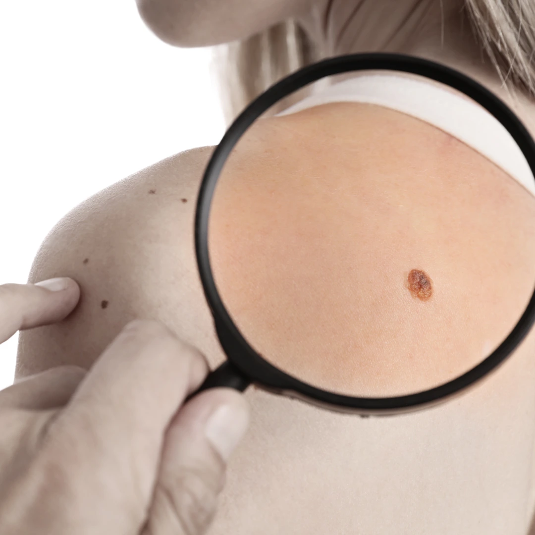 Best Skin Tag Removal in Delhi