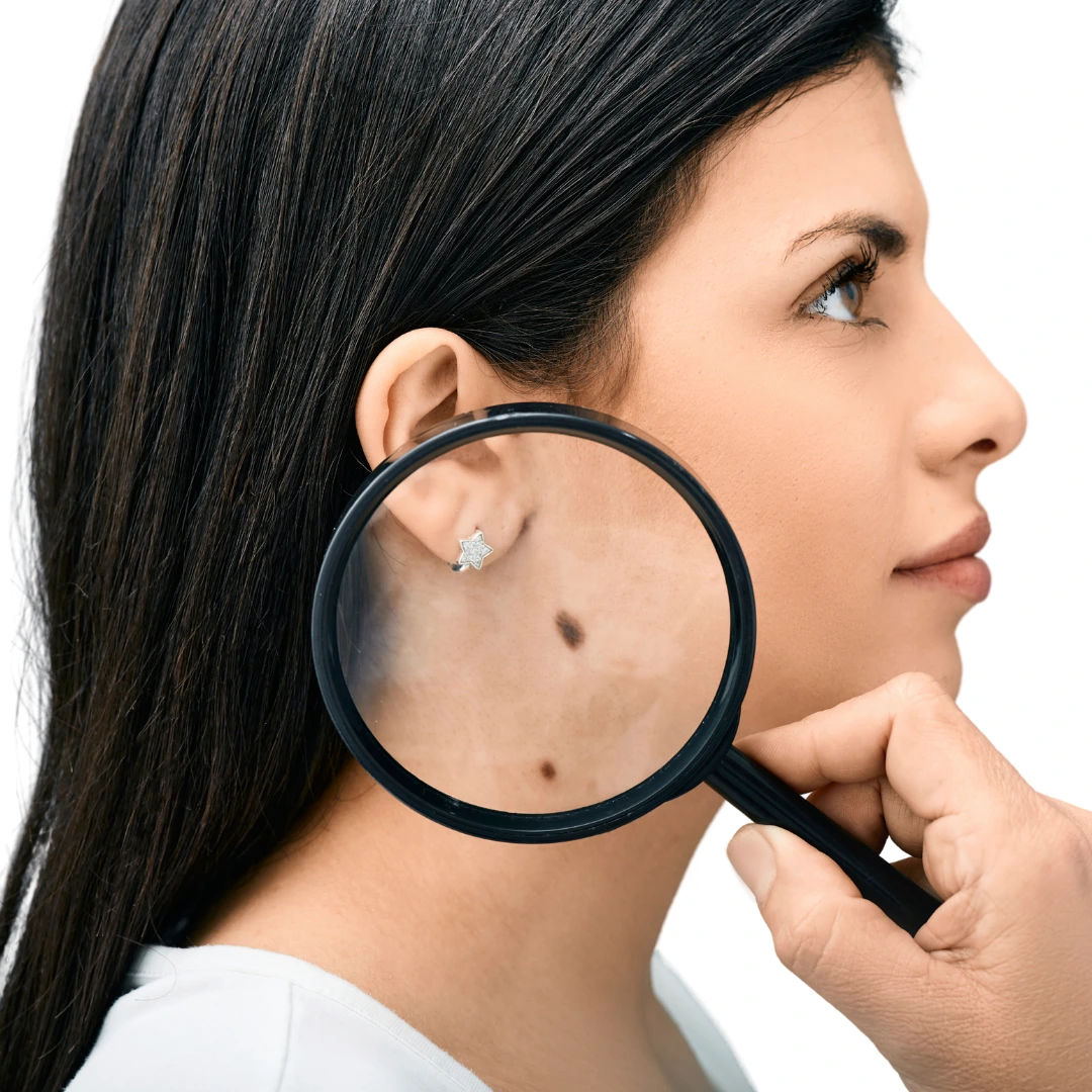 Best Clinic For Mole Removal in Delhi
